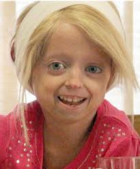 Obat Herbal Progeria